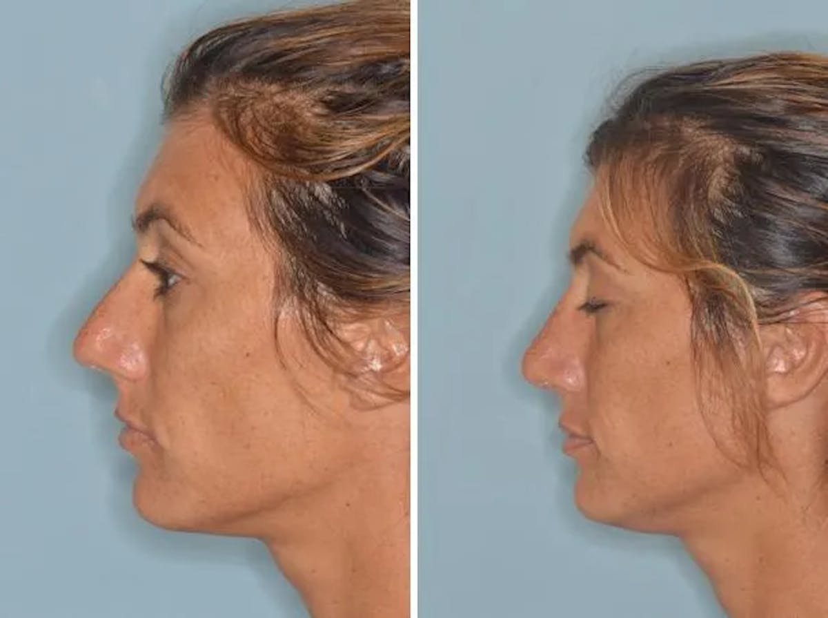 Rhinoplasty before and after, lateral left.