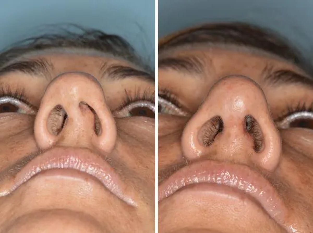 Rhinoplasty before and after, frontal.