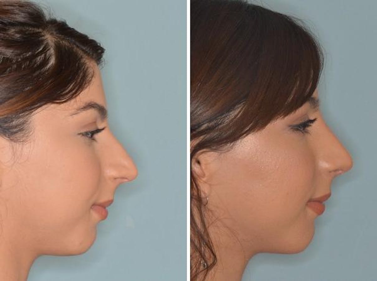 Rhinoplasty before and after, lateral right.