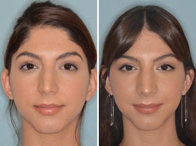 Rhinoplasty before and after, frontal.