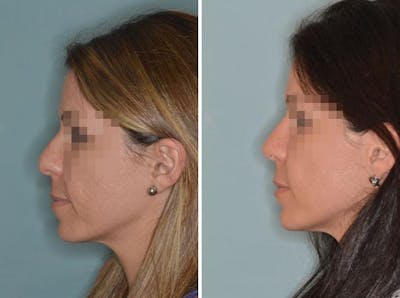 Rhinoplasty before and after, lateral left.