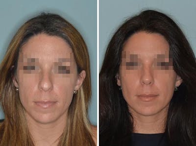 Rhinoplasty before and after, frontal.