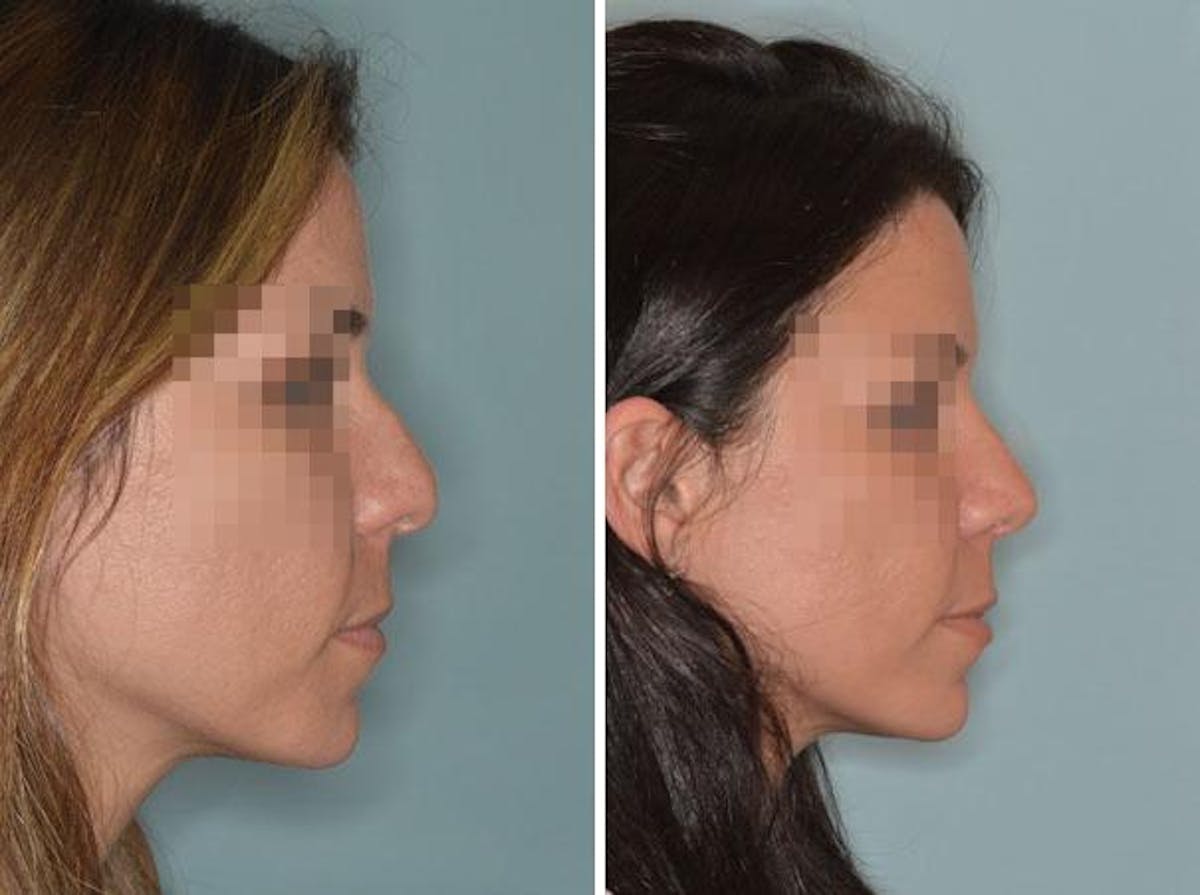 Rhinoplasty before and after, lateral right.