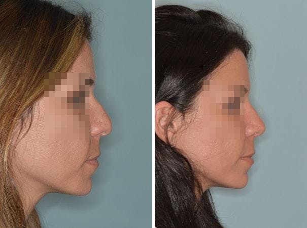 Rhinoplasty before and after, lateral right.
