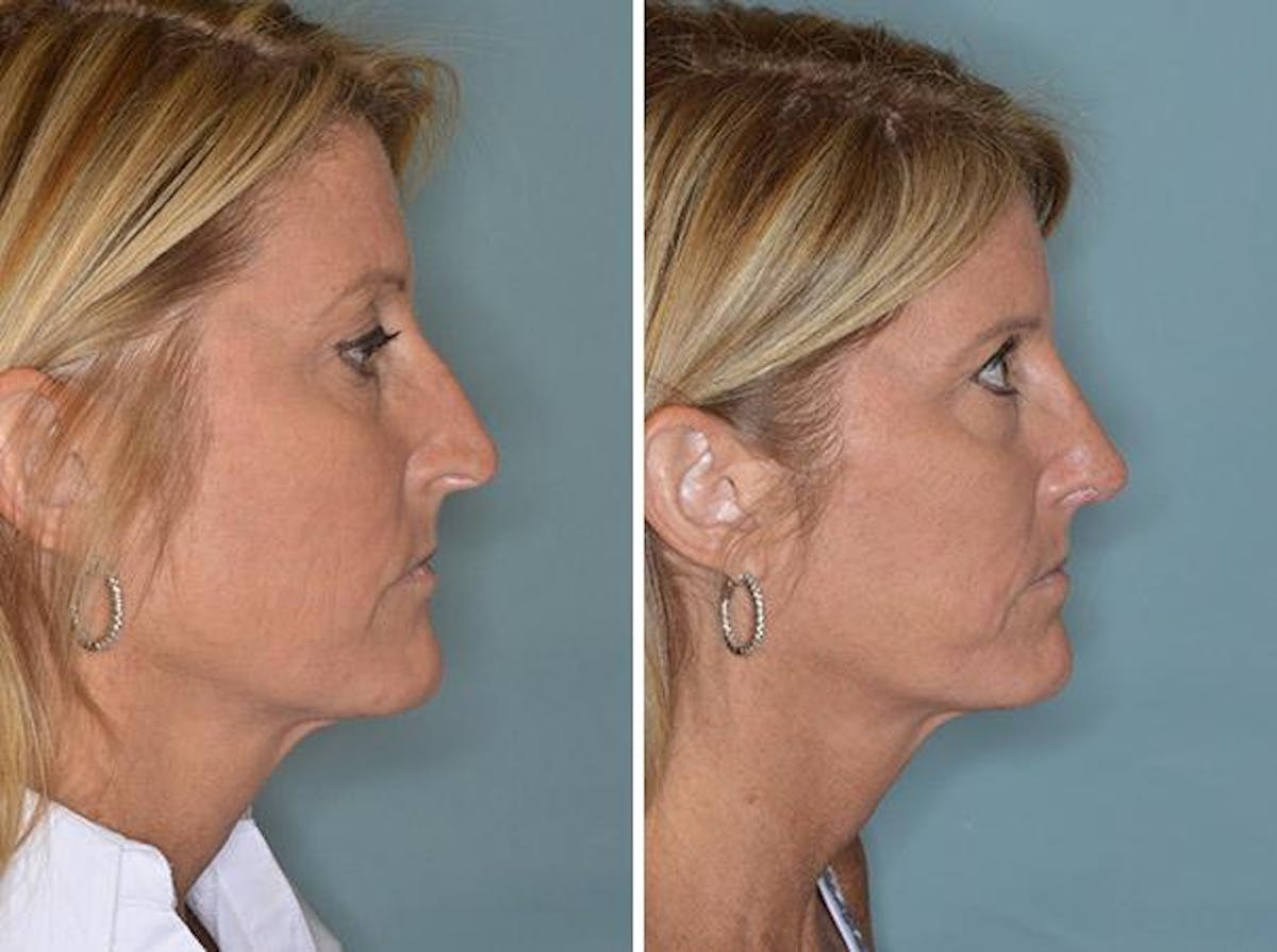 Rhinoplasty before and after, lateral right.