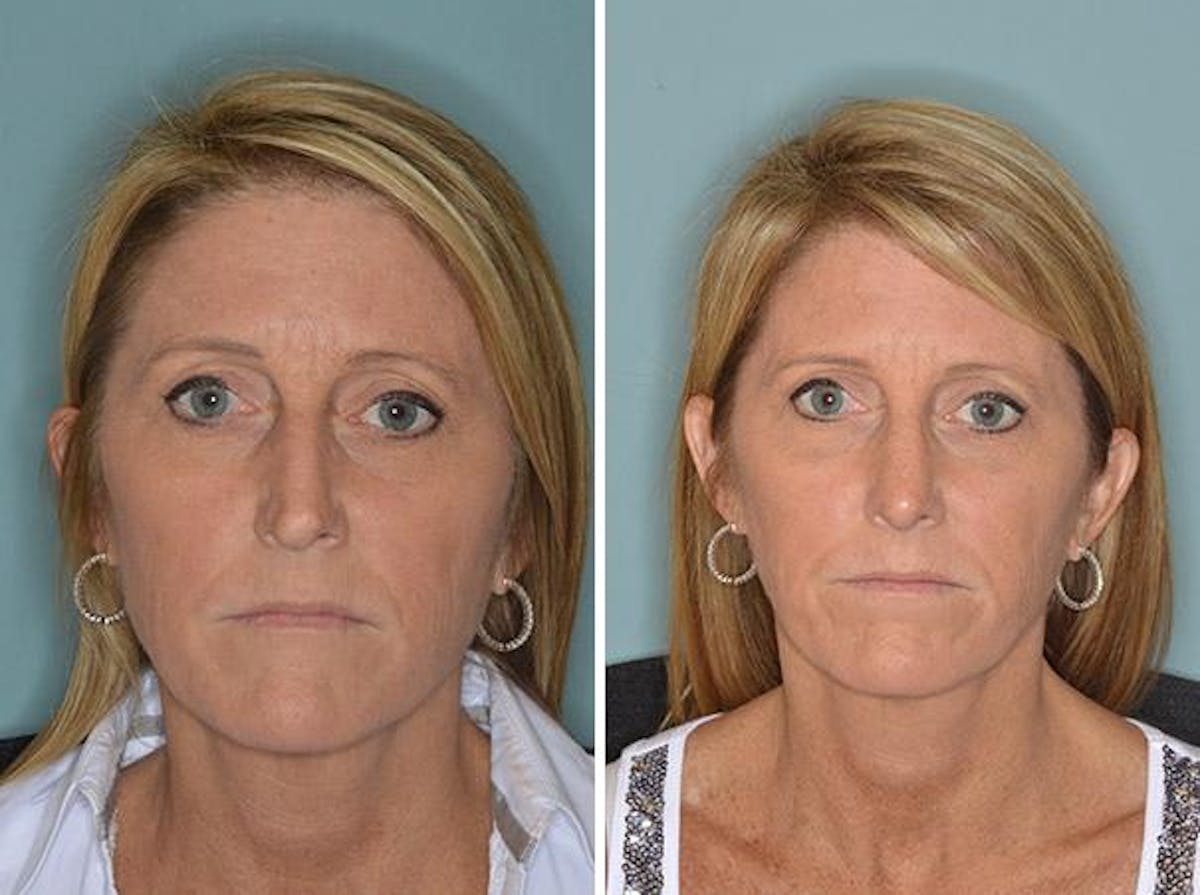 Rhinoplasty before and after, frontal.