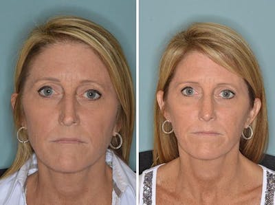 Rhinoplasty before and after, frontal.