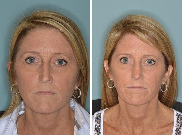 Rhinoplasty before and after, frontal.
