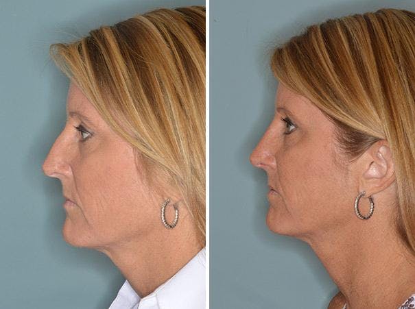 Rhinoplasty before and after, lateral left.