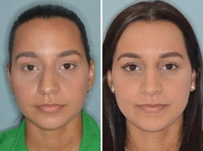 Rhinoplasty before and after, frontal.