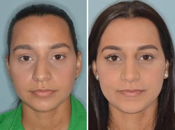 Rhinoplasty before and after, frontal.