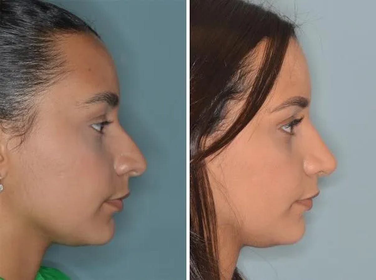 Rhinoplasty before and after, lateral right.
