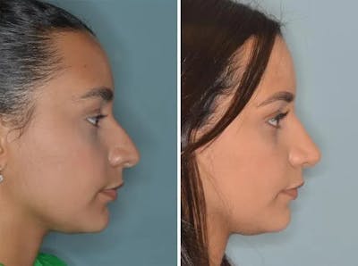 Rhinoplasty before and after, lateral right.