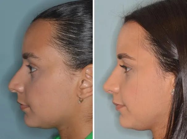 Rhinoplasty before and after, lateral left.