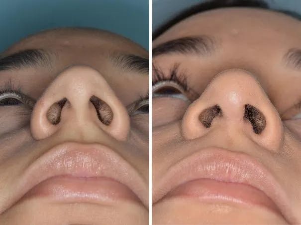 Rhinoplasty before and after, frontal.
