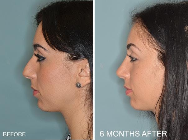 Rhinoplasty before and after, lateral left.