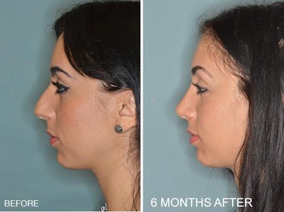 Rhinoplasty before and after, lateral left.