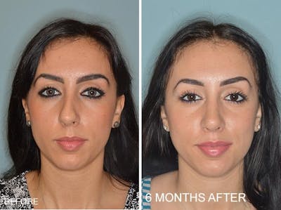 Rhinoplasty before and after, frontal.