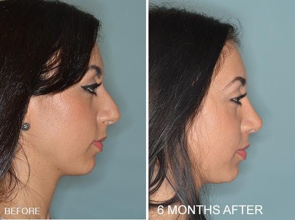 Rhinoplasty before and after, lateral right.