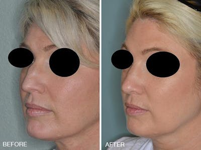 Rhinoplasty before and after, oblique left.