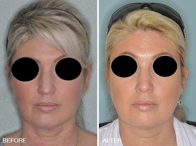 Rhinoplasty before and after, frontal.
