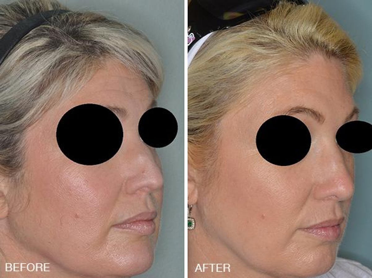 Rhinoplasty before and after, oblique right.