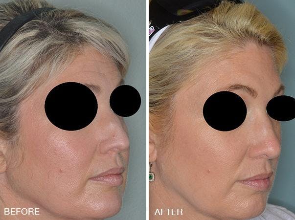 Rhinoplasty before and after, oblique right.