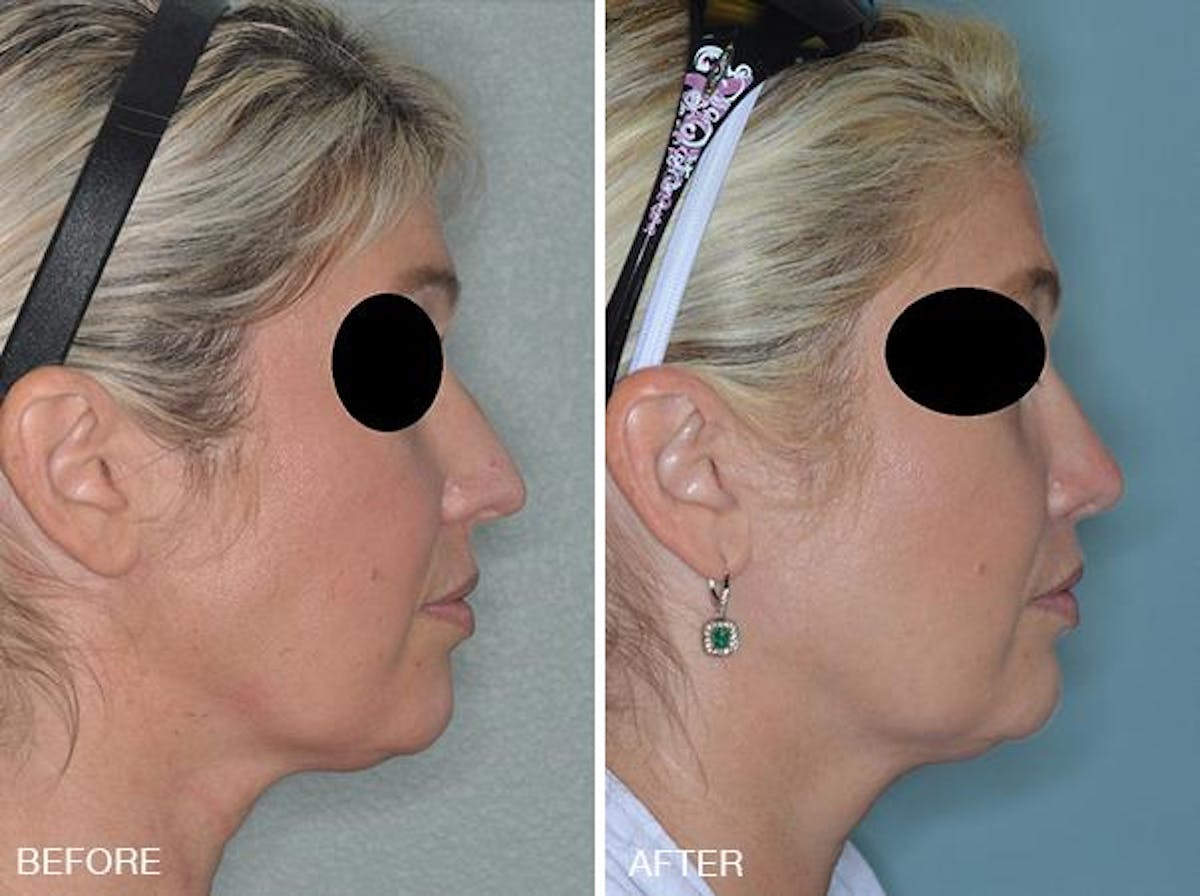 Rhinoplasty before and after, lateral right.