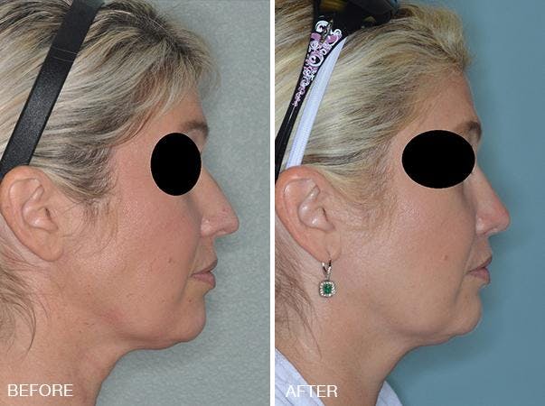 Rhinoplasty before and after, lateral right.