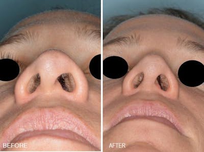 Rhinoplasty before and after, frontal.