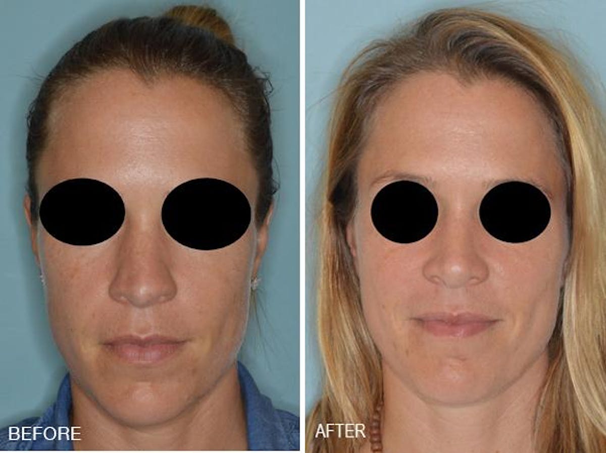 Rhinoplasty before and after, frontal.