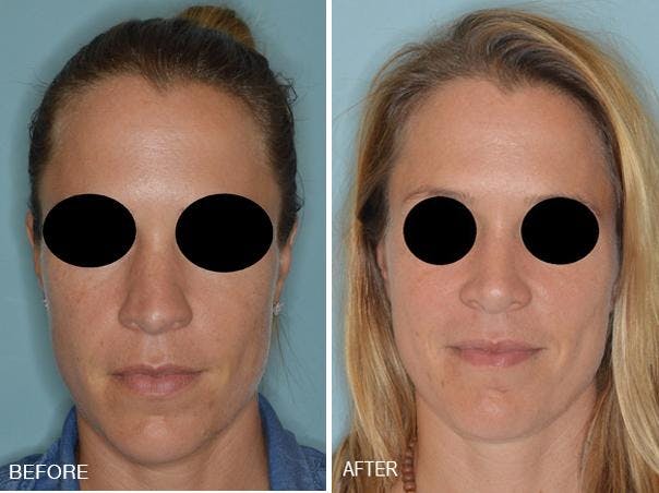Rhinoplasty before and after, frontal.