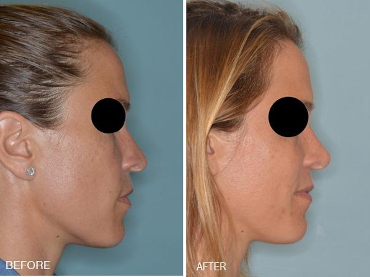 Rhinoplasty before and after, lateral right.