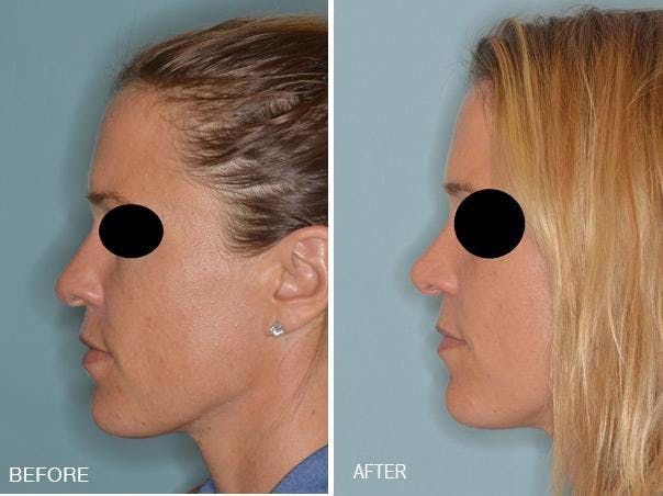 Rhinoplasty before and after, lateral left.