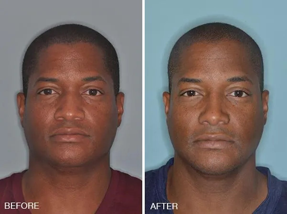 Rhinoplasty before and after, frontal.
