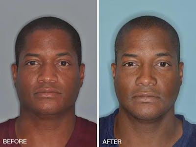 Rhinoplasty before and after, frontal.