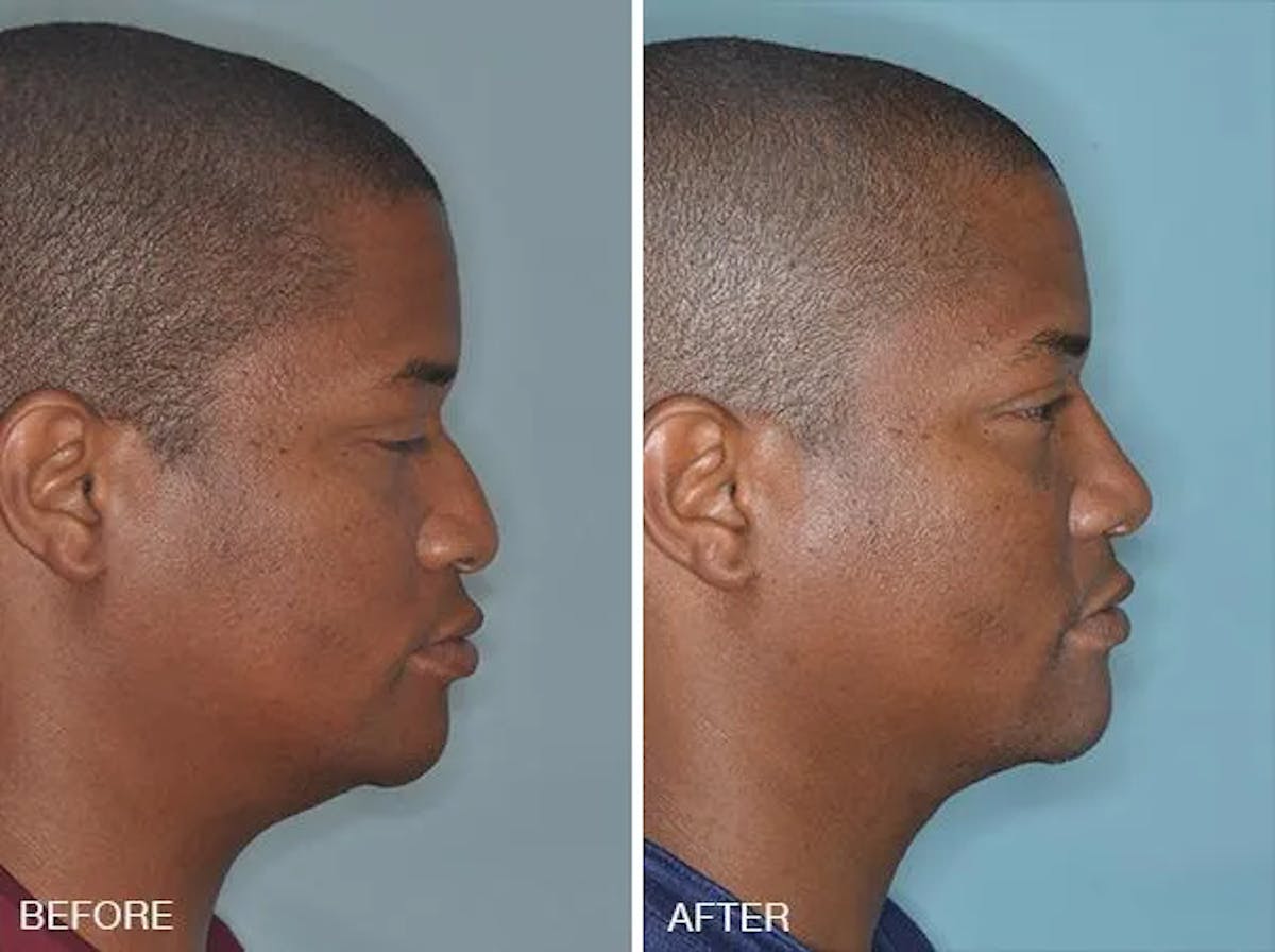 Rhinoplasty before and after, lateral right.