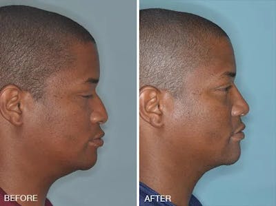 Rhinoplasty before and after, lateral right.