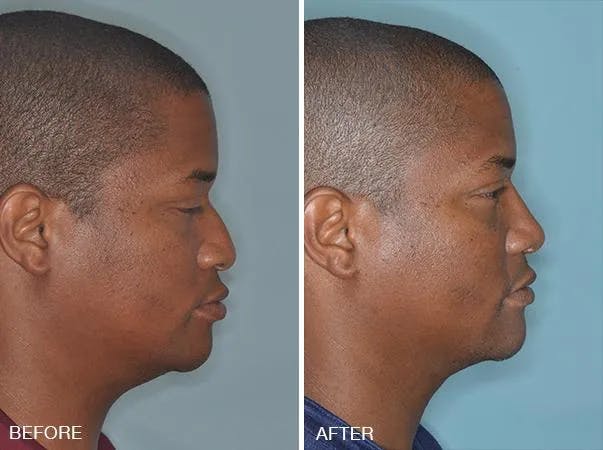 Rhinoplasty before and after, lateral right.
