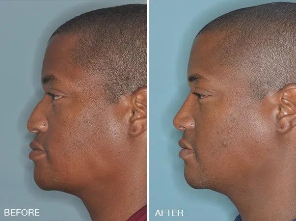 Rhinoplasty before and after, lateral left.