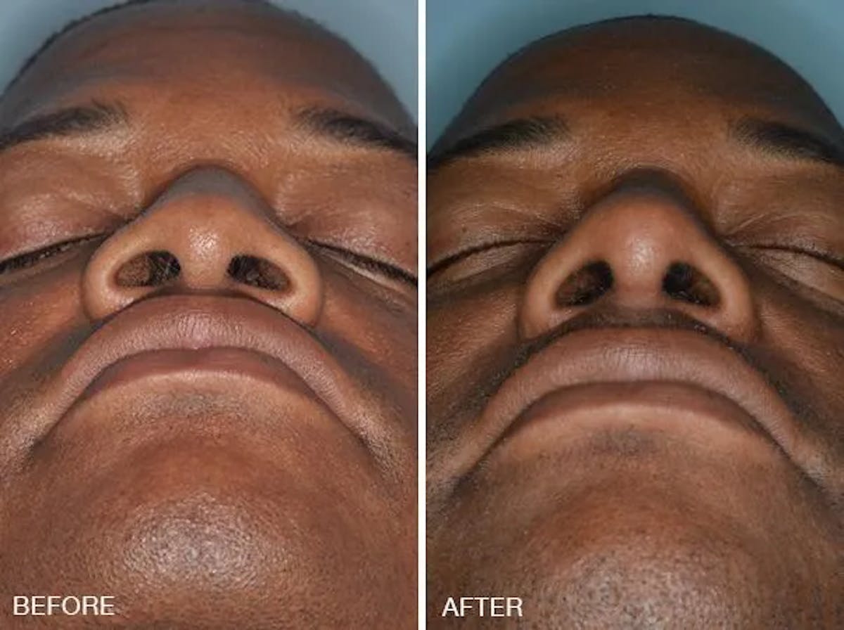 Rhinoplasty before and after, frontal.