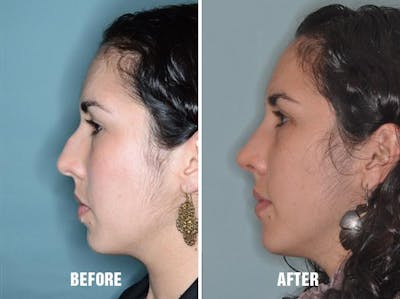 Rhinoplasty before and after, lateral left.