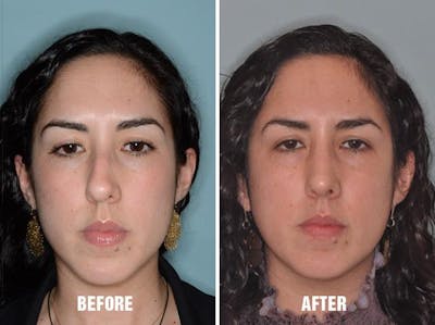 Rhinoplasty before and after, frontal.