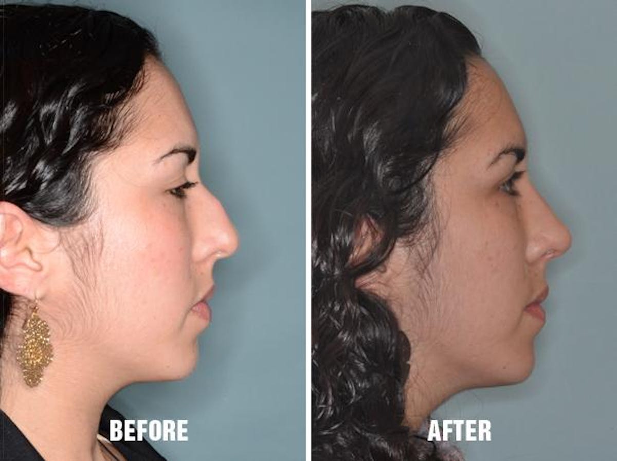 Rhinoplasty before and after, lateral right.
