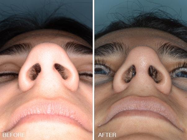 Rhinoplasty before and after, frontal.