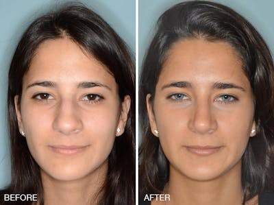 Rhinoplasty before and after, frontal.