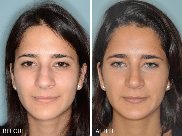 Rhinoplasty before and after, frontal.