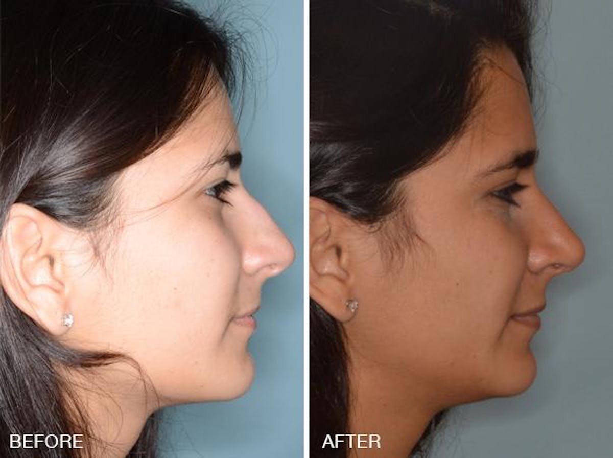 Rhinoplasty before and after, lateral right.