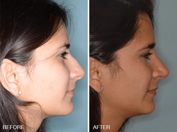 Rhinoplasty before and after, lateral right.