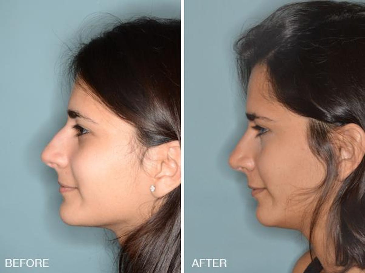 Rhinoplasty before and after, lateral left.